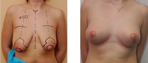 Снимка преди и след уголемяване на гърдите