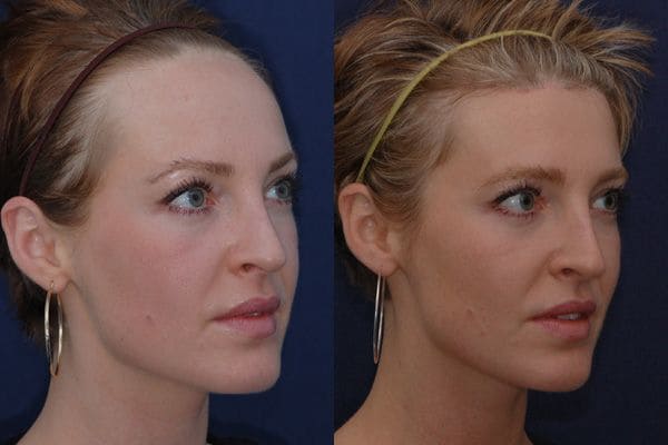 photo avant apres d'abaissement de la ligne frontale chez la femme