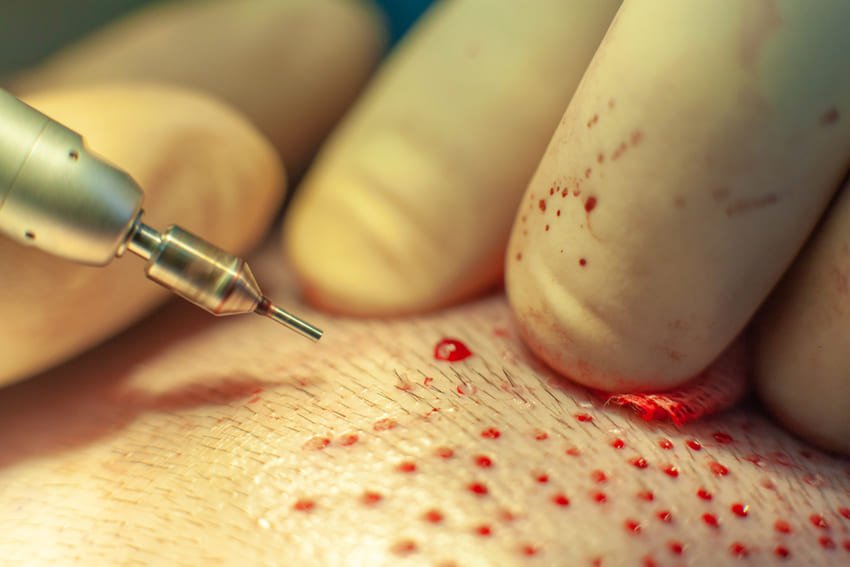 implant de greffon par la méthode DHI