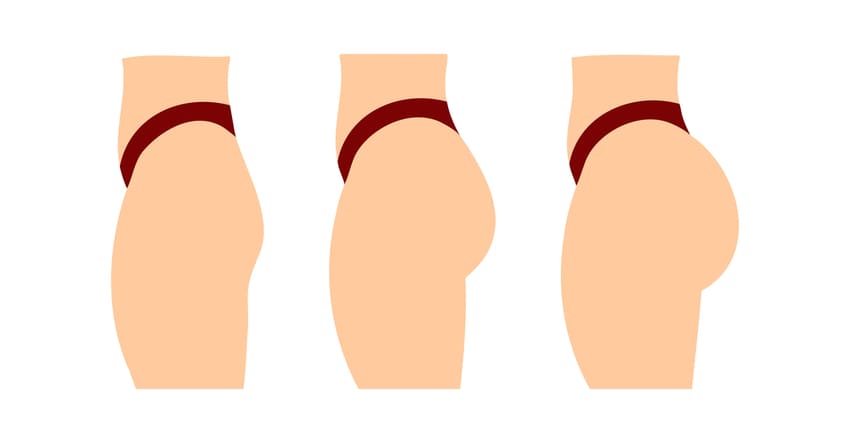 Schéma d'une augmentation de fesses par BBL