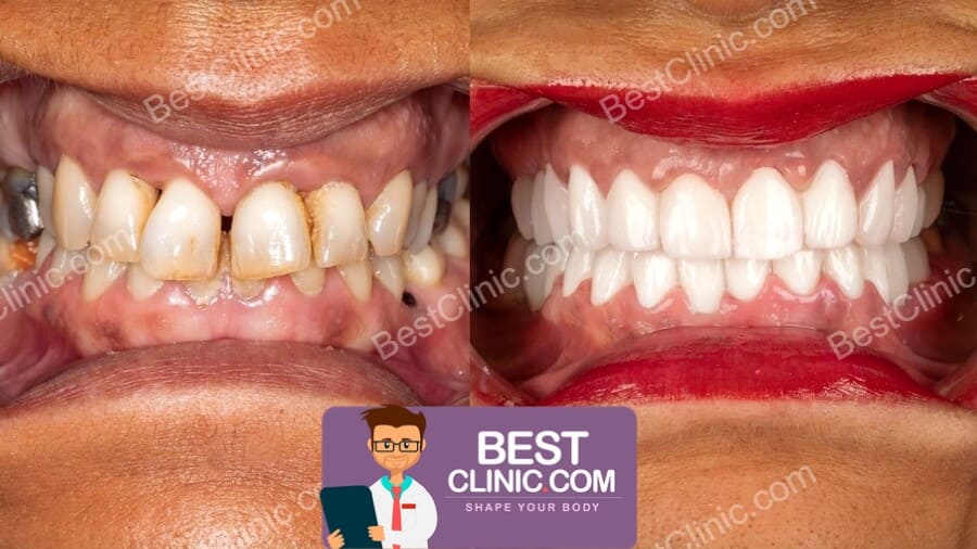 résultat avant apres facette dentaire turquie