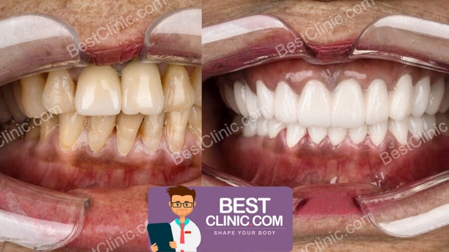 photo avant apres facette dentaire turquie